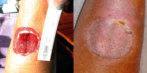 The cookie cutter bite and scar left on Mr. Spalding, from Honebrink et al